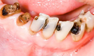 RĂNG KHỎE – TRẺ VUI HỌC: HƯỚNG DẪN CHĂM SÓC VÀ PHÒNG BỆNH RĂNG MIỆNG HỌC ĐƯỜNG