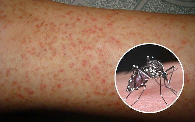 Mắc SXH Dengue là do muỗi vằn đốt